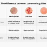 How to Treat Flea Bites on Humans