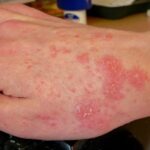 Human Meds for Dog Rash